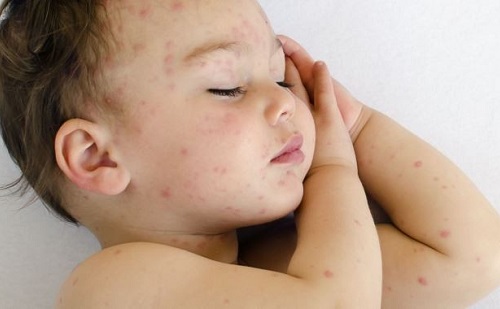 Sikeres a bárányhimlő elleni védőoltásért indított kampány